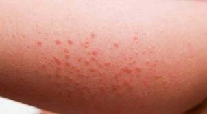 What are the symptoms of a streptococcus rash?